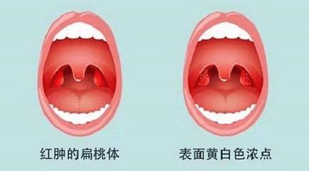 扁桃体一个月发炎三次