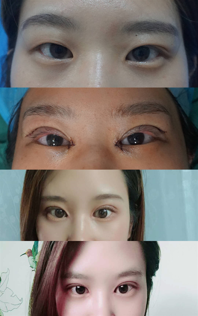 双眼皮什么时候做最好