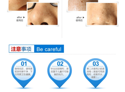 痘痘针是什么
