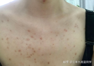 夏天背上起了很多痘痘