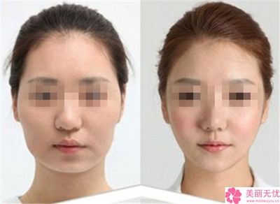瘦脸针的作用是什么