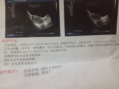 胎儿心跳是什么声音