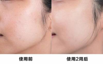 敏感肌脸上总是小痘痘