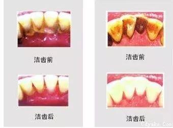 洗牙怎么样