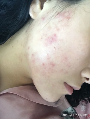 脸颊长痘痘红肿