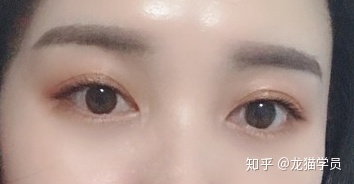双眼皮割的太窄了