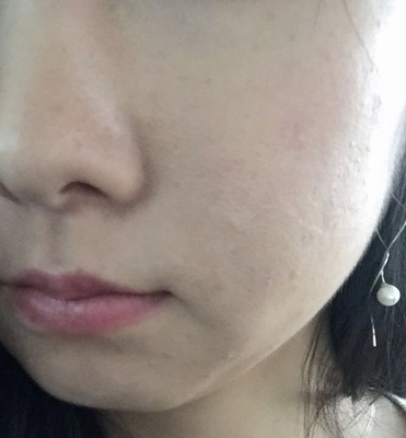痘痘可以用遮瑕