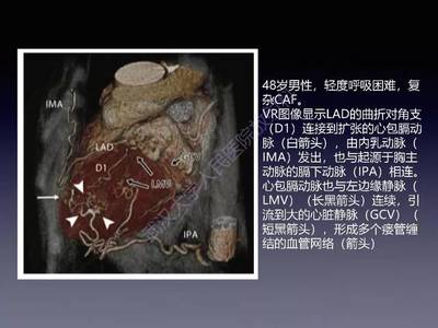 冠状动脉瘘怎么治疗
