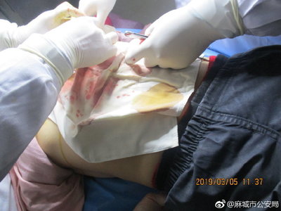 怎么鉴定轻伤