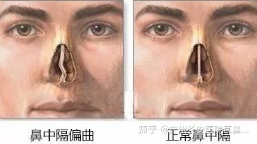 鼻中隔偏曲怎么治疗