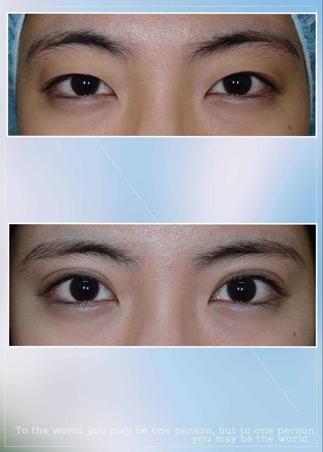 双眼皮成功案例