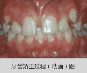 虎牙牙齿矫正矫正