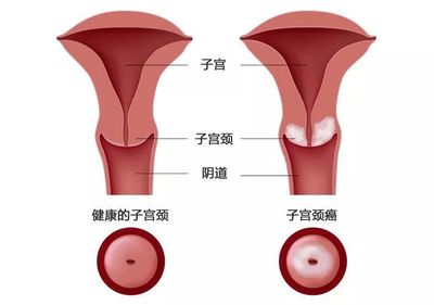 宫颈纳囊怎么治疗最好的方法