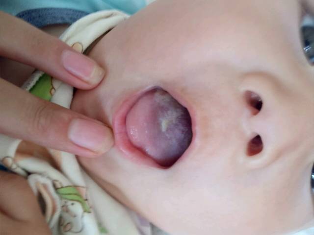 宝宝舌苔中间缺一块