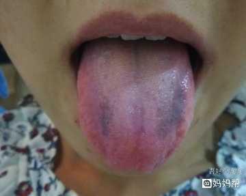 舌头发黑是怎么回事
