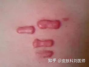 怎样能治好痘痘