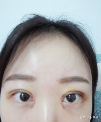 双眼皮就剩睫毛根部肿
