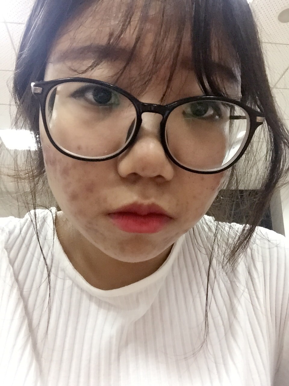 额头长了囊肿痘痘