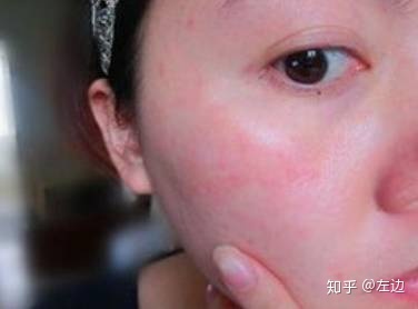 脸红肿是怎么回事