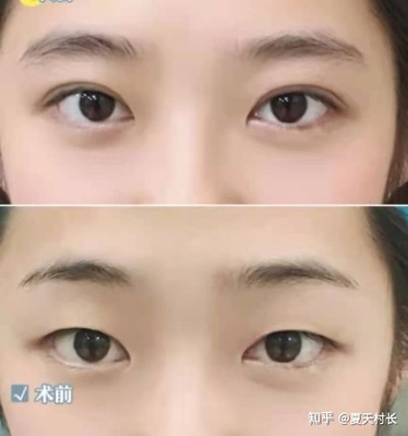 双眼皮 济南