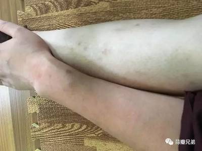 左边嘴巴长痘痘是什么原因