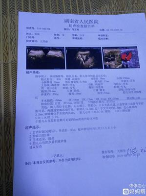 胎儿心包腔少量积液