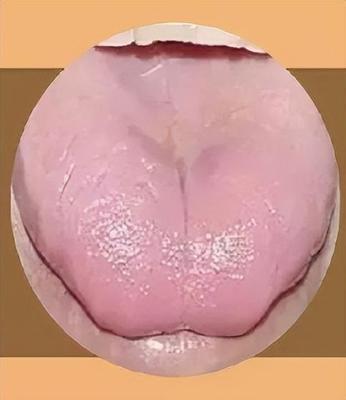舌尖裂纹是怎么回事