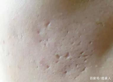 微针后长痘痘
