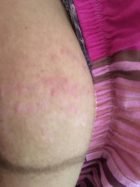 腹部长痘痘
