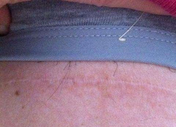 剖腹产刀疤多少钱