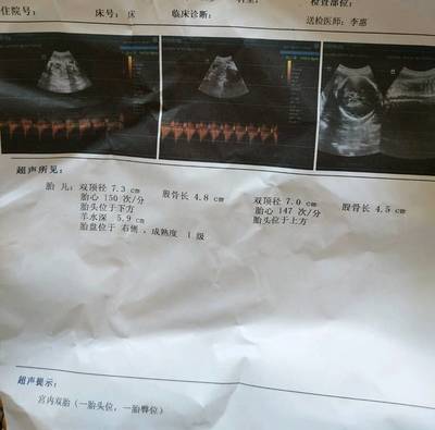 彩超 怀孕