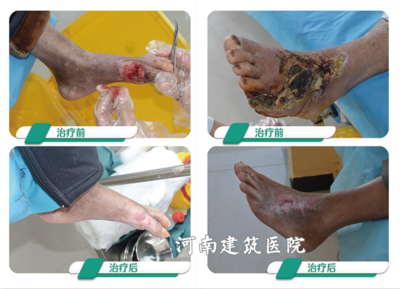 下肢血管堵塞怎么治疗