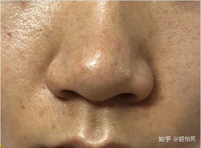 男生脸部毛孔粗大怎么办