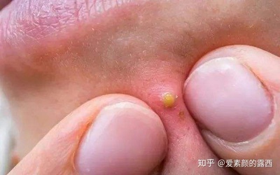 痘痘该不该挤