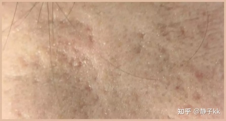 挤痘痘后毛孔粗大怎么办