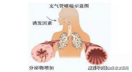 气管有鸣音是怎么回事