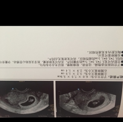 怀孕8周胎儿图片欣赏