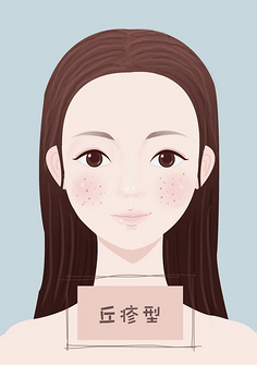 丘疹型痘痘回留疤吗