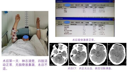 经鼻蝶微创垂体囊肿手术费用多少钱