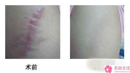 疤痕软化针的价格