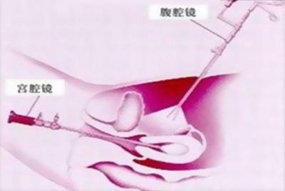 输卵管伞端粘连应该怎么治疗