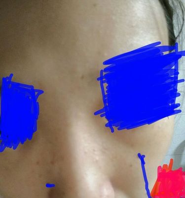 鼻头两侧痘痘怎么办