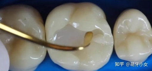 补牙后隐隐作痛