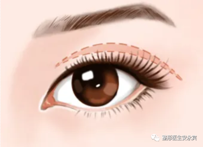 想做双眼皮