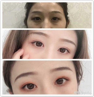 全切双眼皮照片