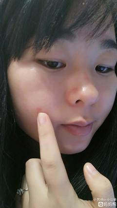 脸上起痘痘留疤怎么办