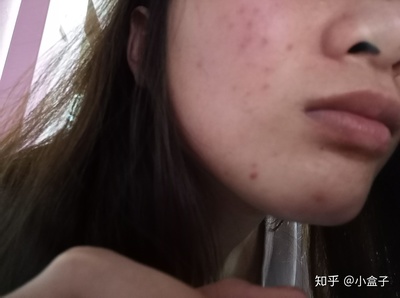 鼻子和鼻翼长痘痘
