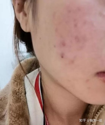 去美容院针清痘痘好吗