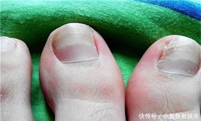 脚趾甲发白是怎么回事