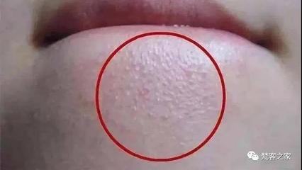 痘痘好了后留下脂肪粒